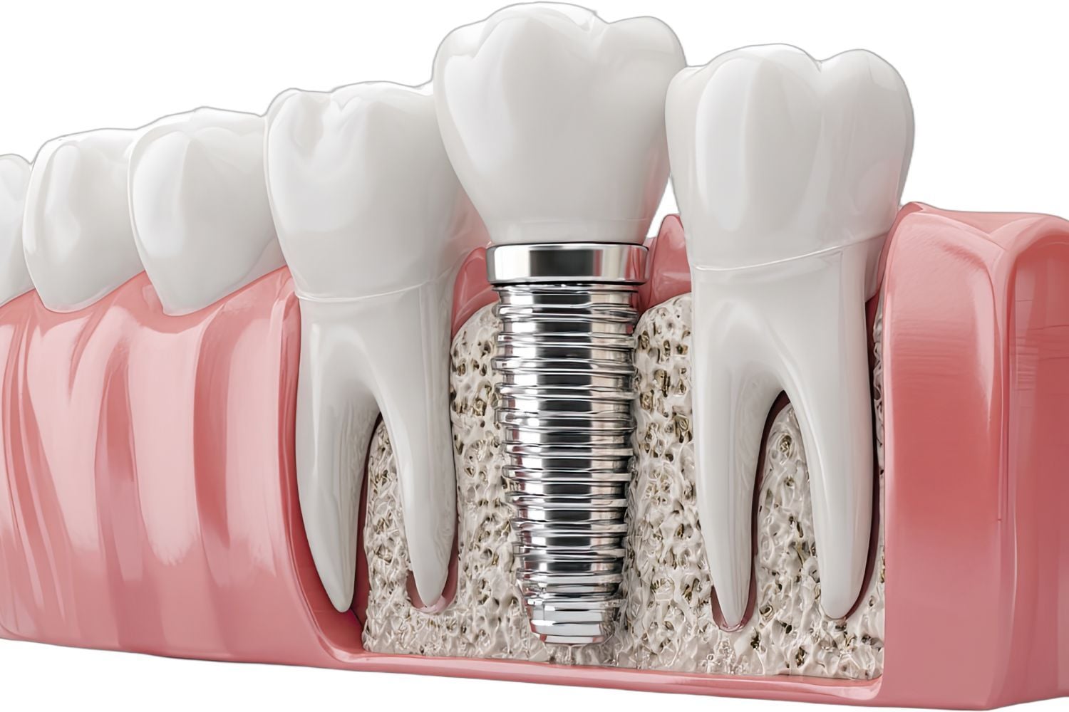How Much Do Dental Implants Cost in Calgary (2026 Guide) How Much Do Dental Implants Cost in Calgary (2026 Guide)